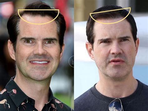 has jimmy carr had a hair transplant